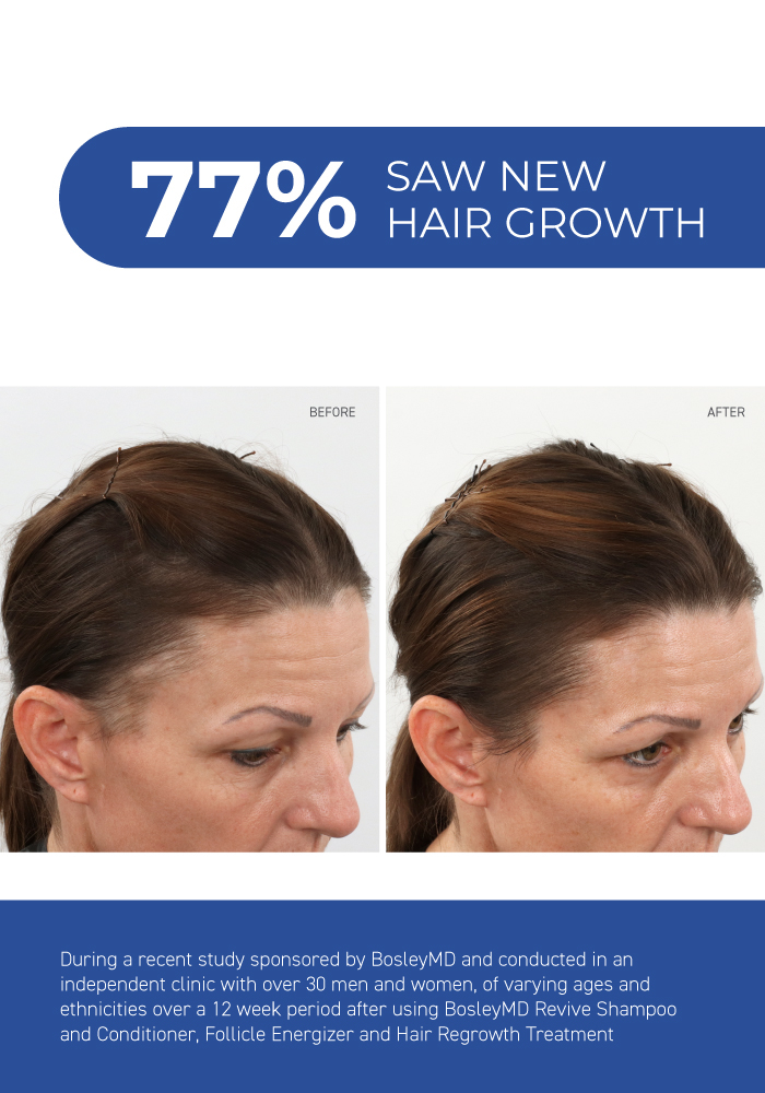 BosleyMD Womens Hair Regrowth Treatment Foam with Minoxidil | SalonCentric BosleyMD Womens Hair Regrowth Treatment Foam with Minoxidil | SalonCentric